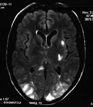 高血圧脳症MRI画像